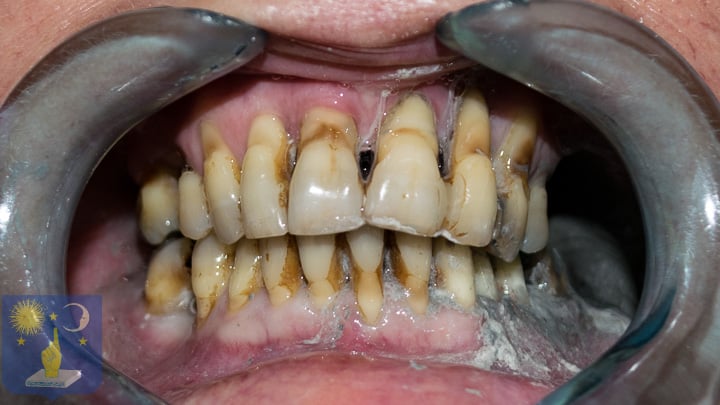 gum disease periodontitis