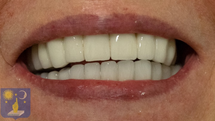 dental restoration with basal implants for gum disease